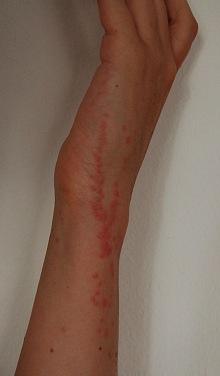 Jak vypadá kousnutí od štěnice 3